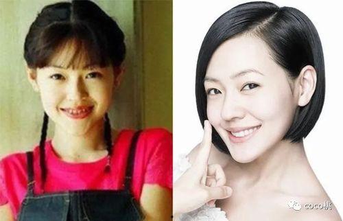 明星们带牙套,牙套助力颜值升级